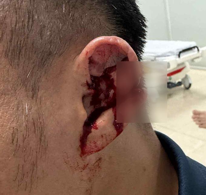 Trọng Hoàng bị giẫm rách tai, vẫn quật cường thi đấu đến cuối trận